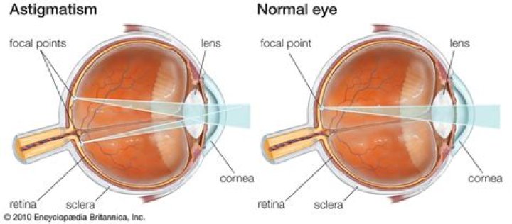 What is Astigmatism?