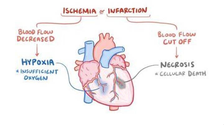 What is the difference between infarction and ischemia?