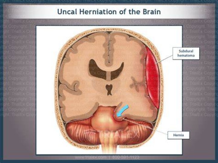 Where is the uncal herniation?