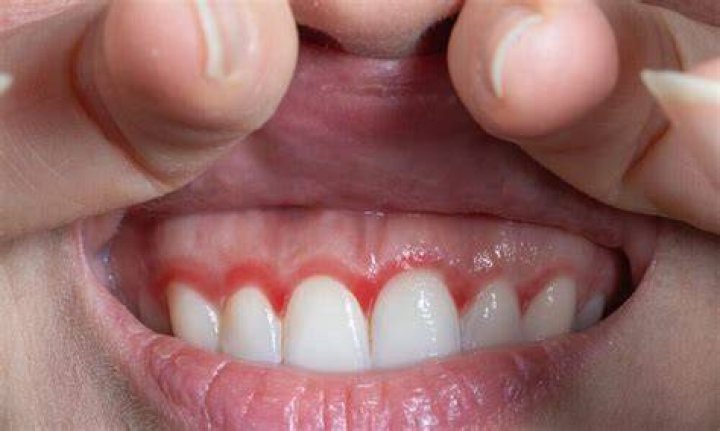 Why are my gums red after dental cleaning?