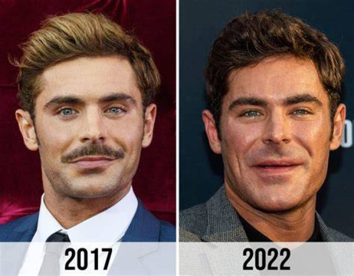 Zac Efron Broken Jaw Why Does He Look Different Promoting 'Iron Claw'?