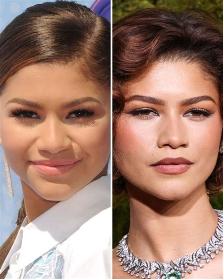 Zendaya's Plastic Surgery Journey Explored
