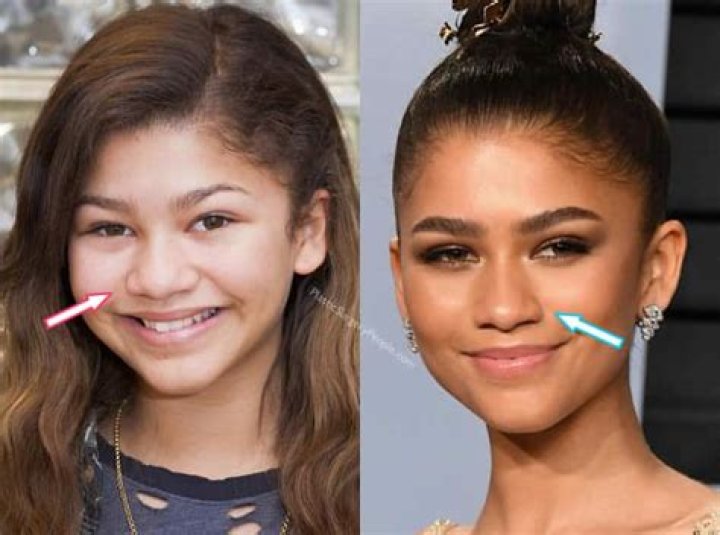 Zendaya Plastic Surgery Before and After Plastic Surgery Magazine