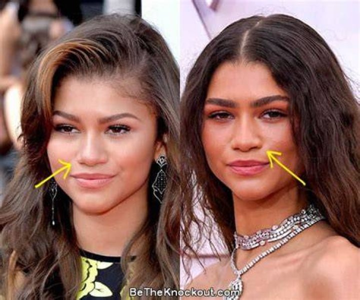 Zendaya Plastic Surgery Comparison Photos